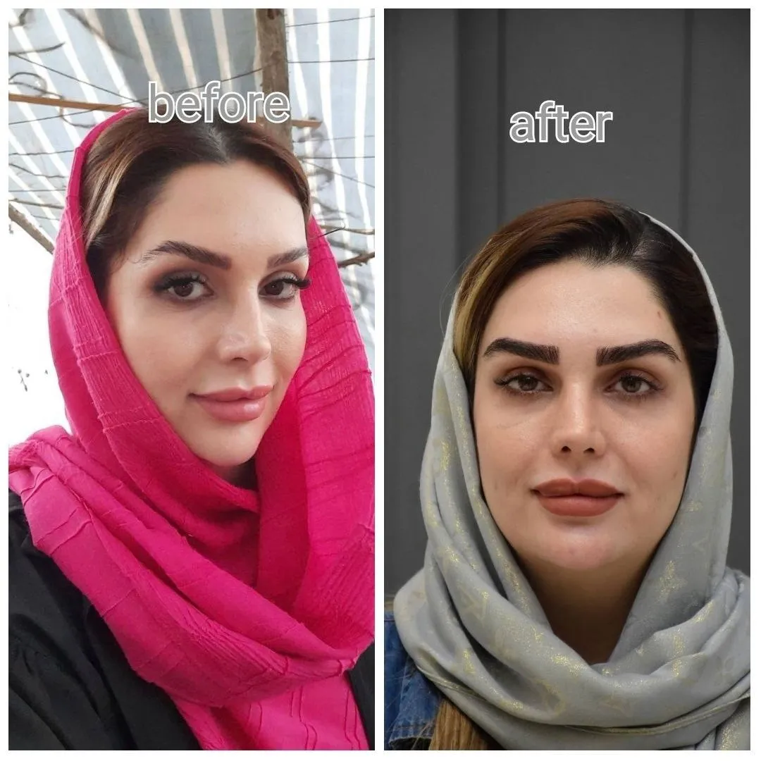 قبل و بعد کاشت ابرو