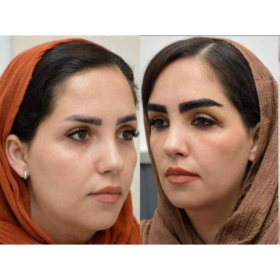 قبل و بعد کاشت ابرو