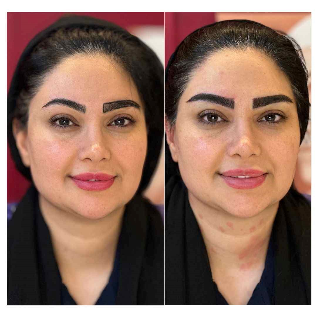 قبل و بعد کاشت ابرو