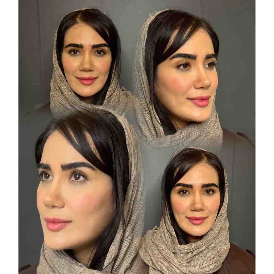 قبل و بعد کاشت ابرو
