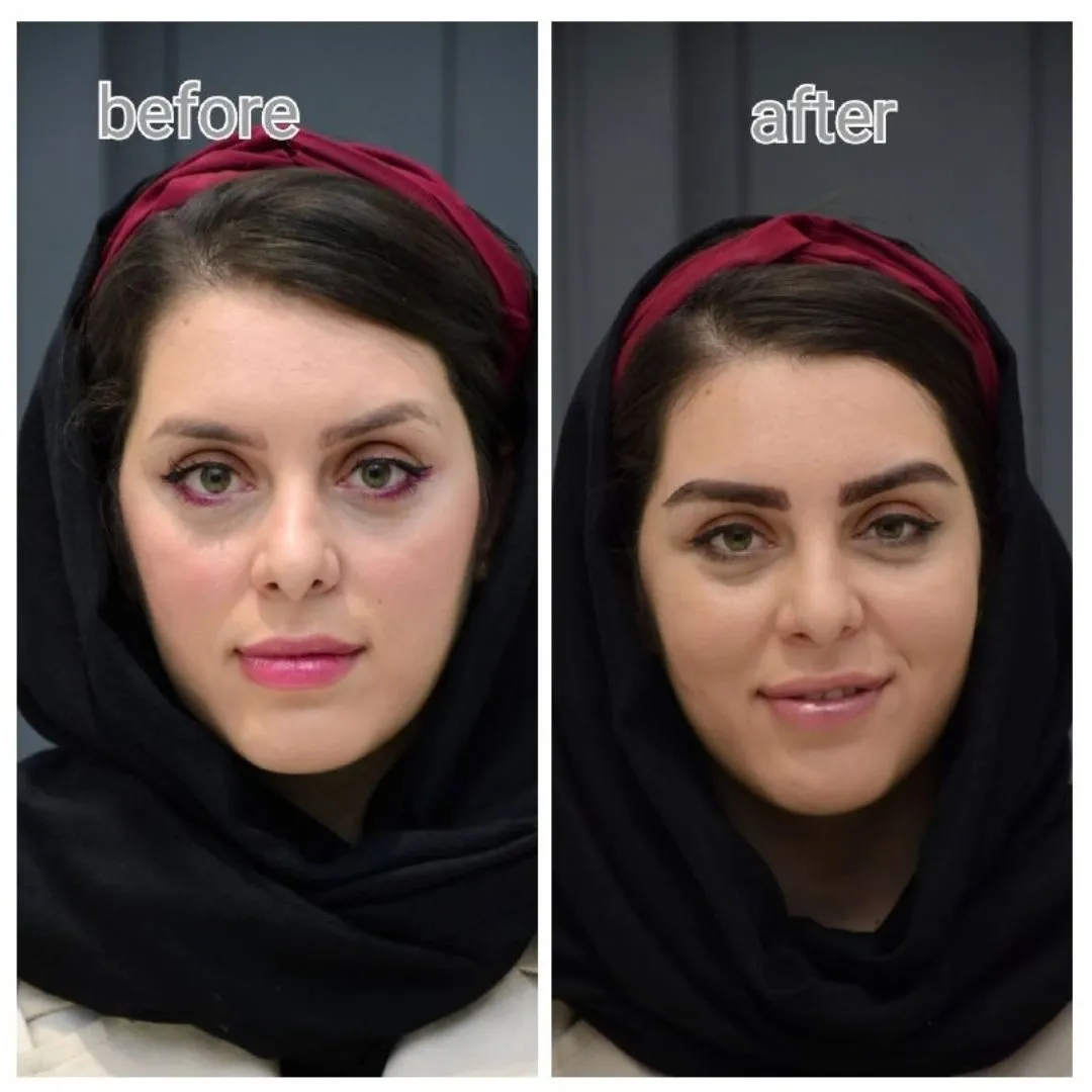 قبل و بعد کاشت ابرو