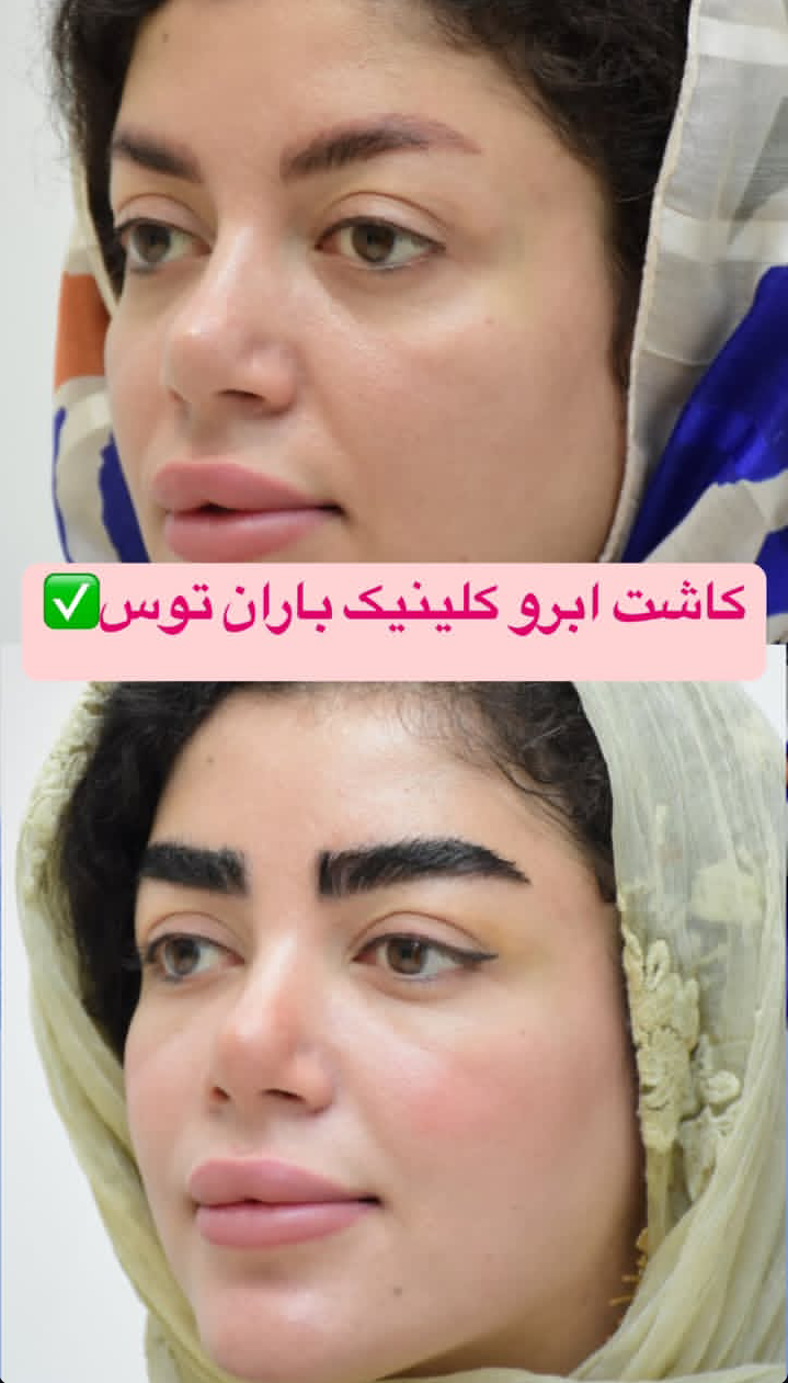 قبل و بعد کاشت ابرو روی تاتو 4
