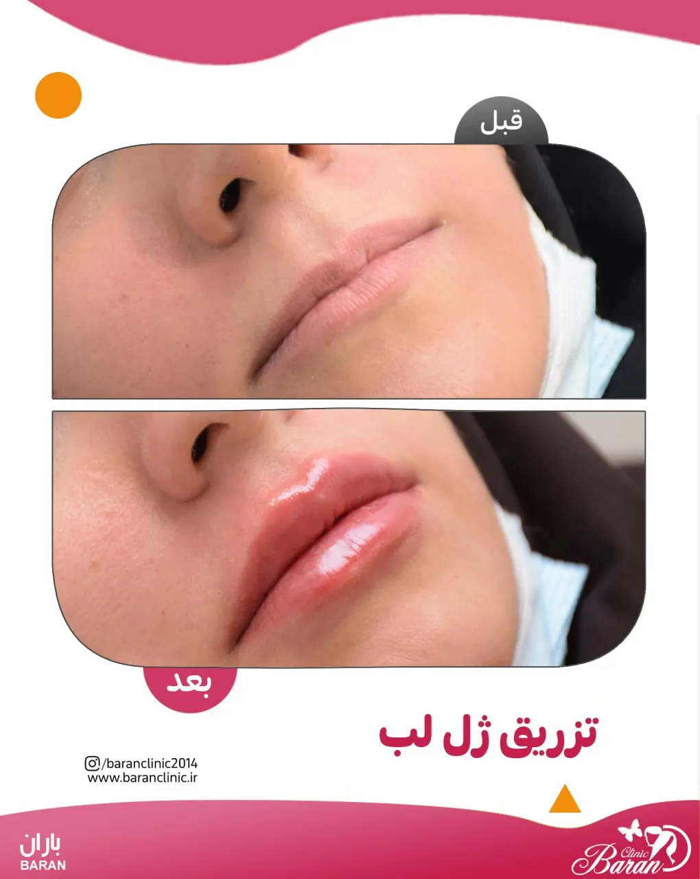 نمونه کار تزریق ژل لب در کلینیک باران توس؛ تصویر 5
