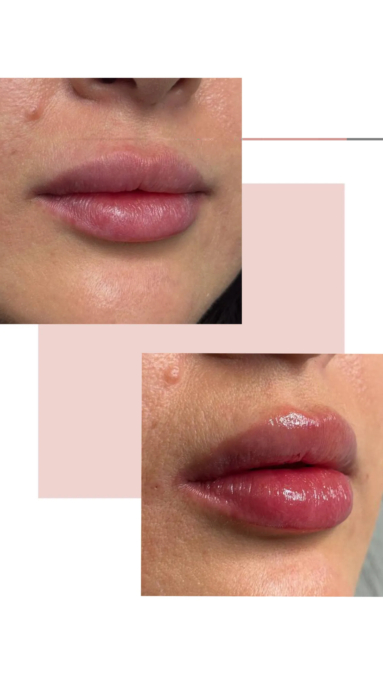 نمونه کار تزریق ژل لب در کلینیک باران توس؛ تصویر 3