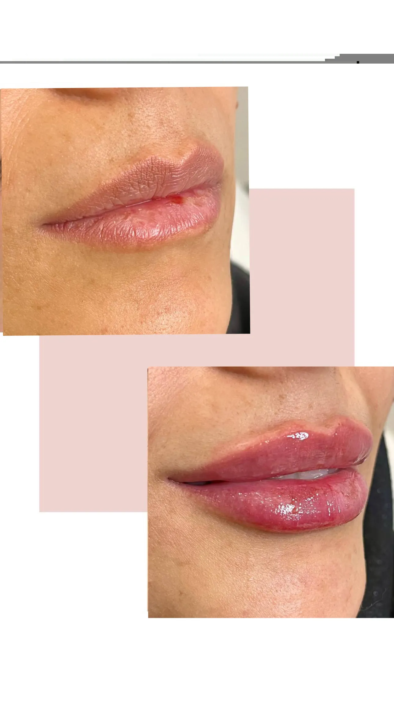 نمونه کار تزریق ژل لب در کلینیک باران توس؛ تصویر 2