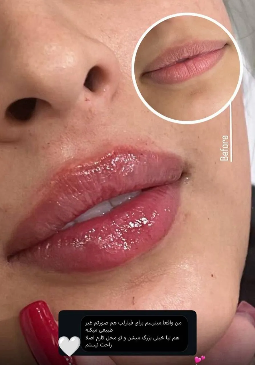 نمونه کار تزریق ژل لب در کلینیک باران توس؛ تصویر 6