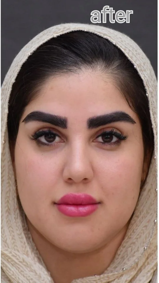 بعد از کاشت ابرو، نمونه ۱