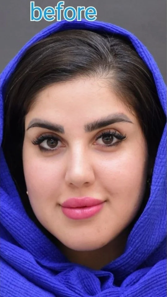 قبل از کاشت ابرو، نمونه ۱