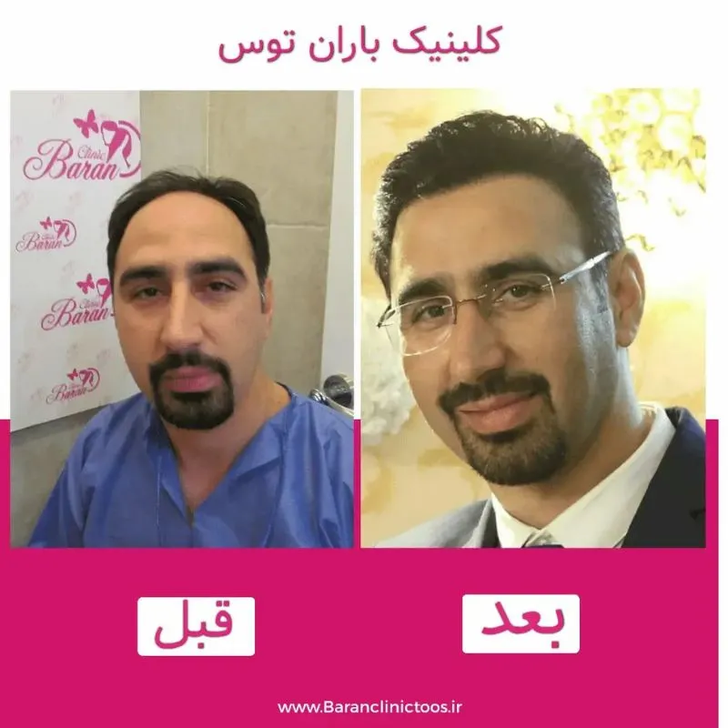 کاشت مو