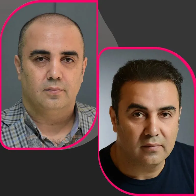 کاشت مو