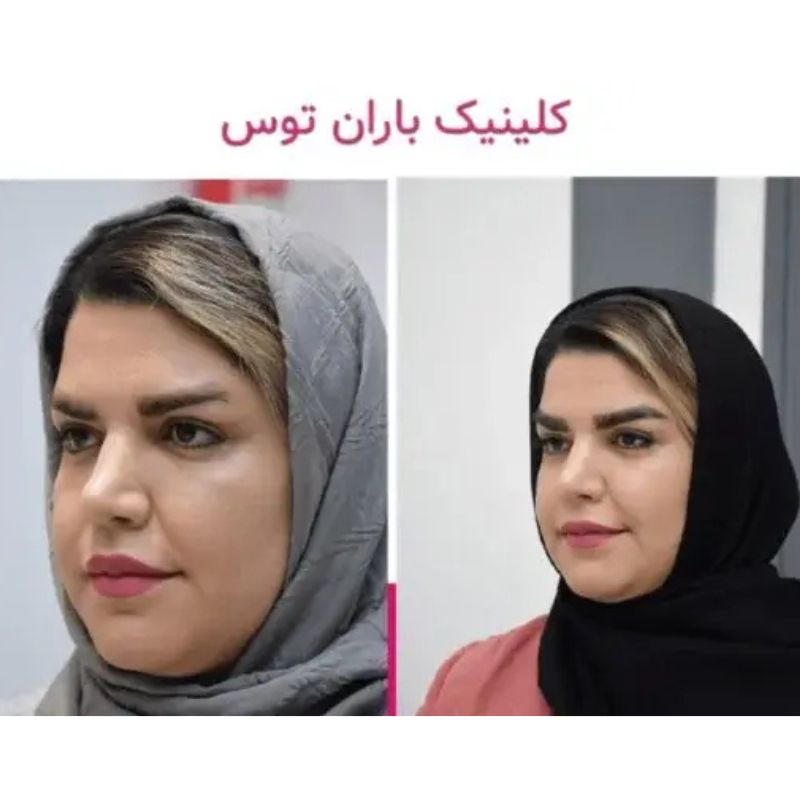 کاشت ابرو