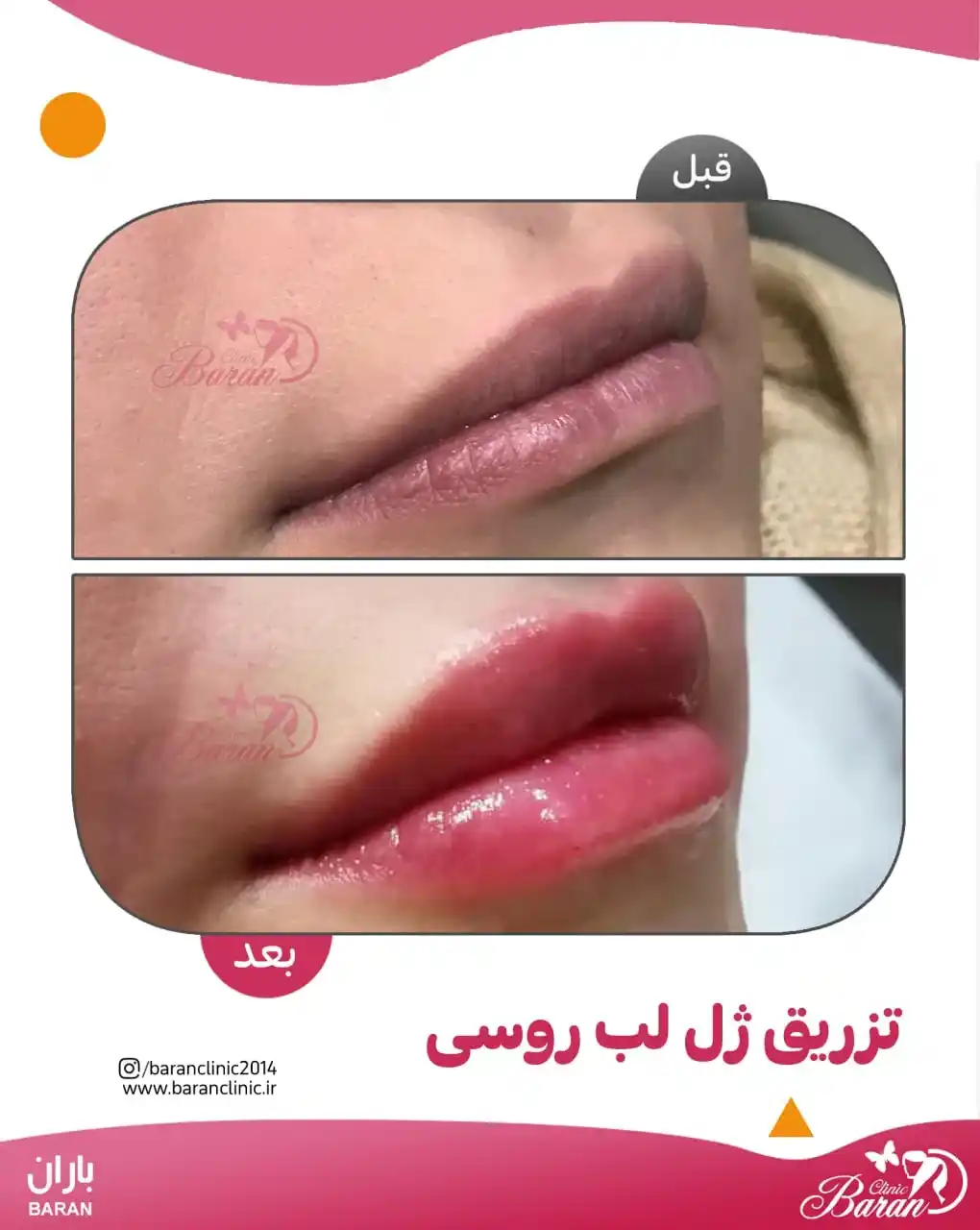 ژل لب