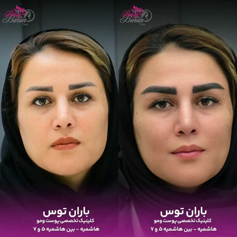 کاشت ابرو