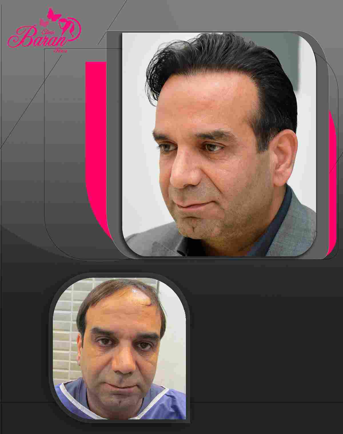 کاشت مو