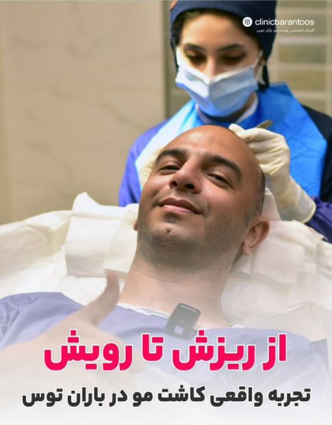 کاشت مو