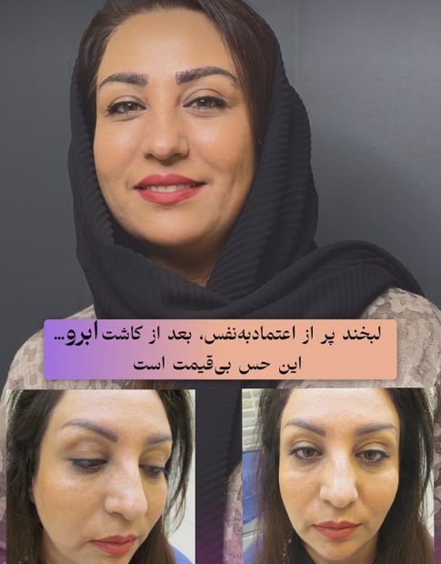 کاشت ابرو
